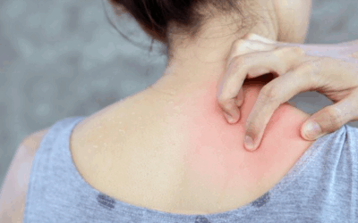 Wat zijn allergien precies